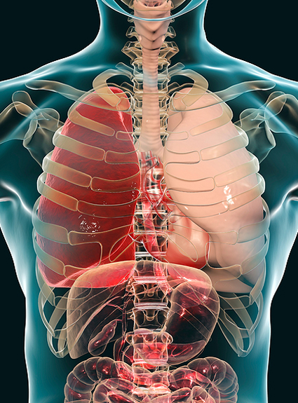 Pneumonia Medical Concept, 3d Illustration Showing Lobar Pneumon